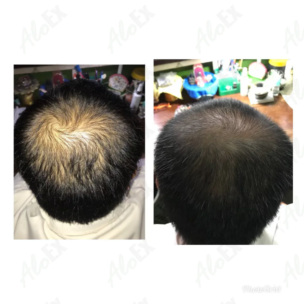 ก่อนใช้-หลังใช้ ผลิตภัณฑ์ AloEx