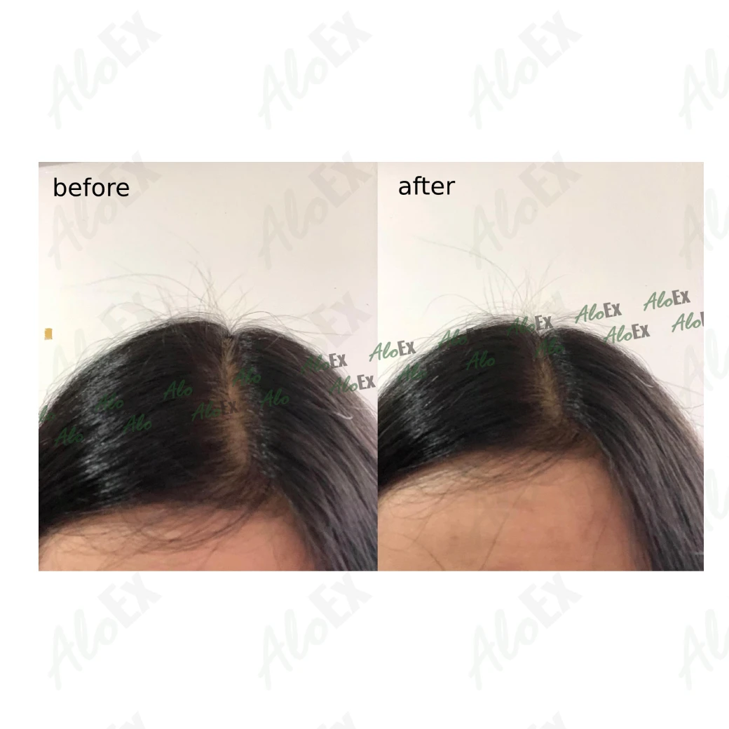 ก่อนใช้-หลังใช้ ผลิตภัณฑ์ AloEx