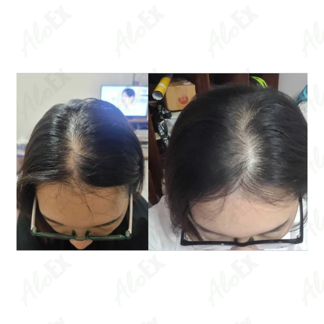 ก่อนใช้-หลังใช้ ผลิตภัณฑ์ AloEx