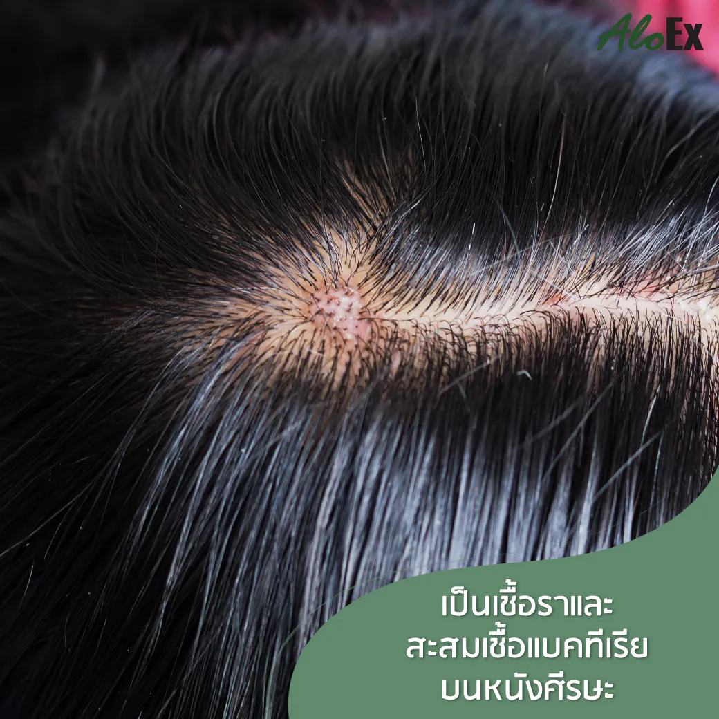 หนังศีรษะมันและรังแคเพิ่มขึ้นจากการนอนตอนผมเปียก