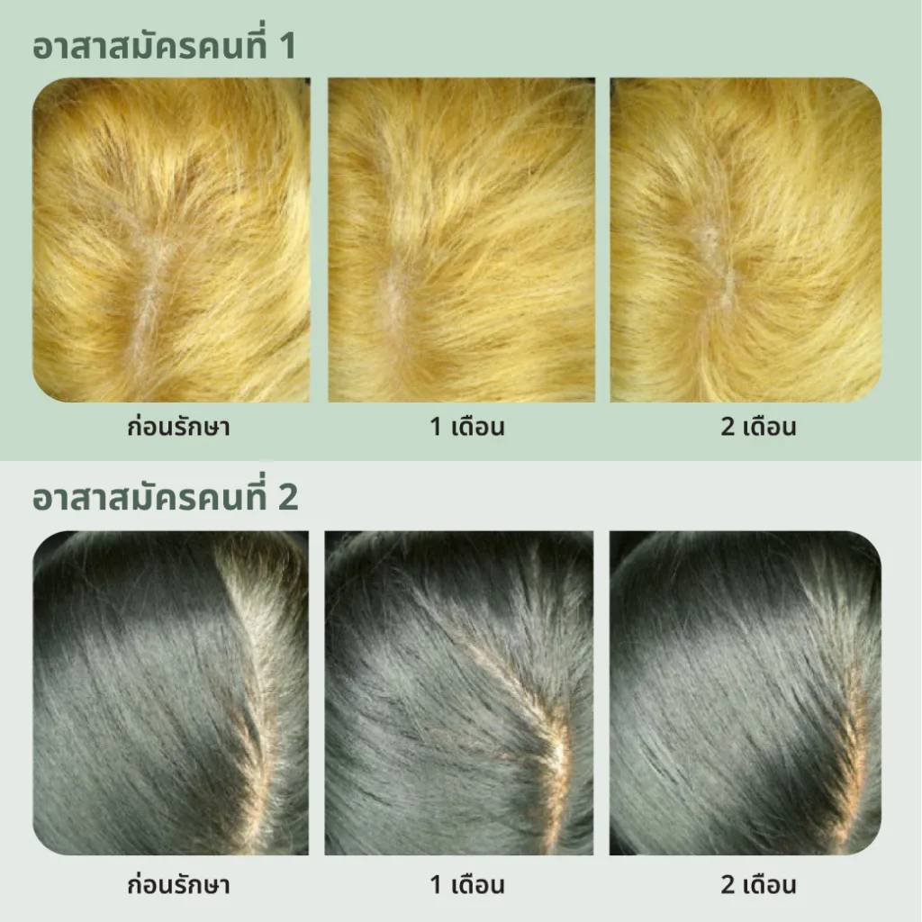 ผลทางคลินิกแสดงการเพิ่มความหนาแน่นของเส้นผมหลังใช้ Apple Stem Cell