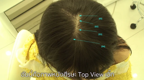 หนังศีรษะบอบบางแพ้ง่ายจากการใช้ผลิตภัณฑ์ที่มีซิลิโคน