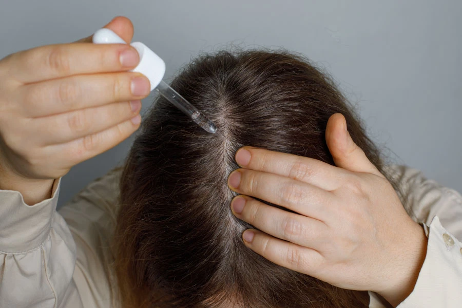 ยา Minoxidil แบบทาสำหรับลดผมร่วงและกระตุ้นผมงอกใหม่