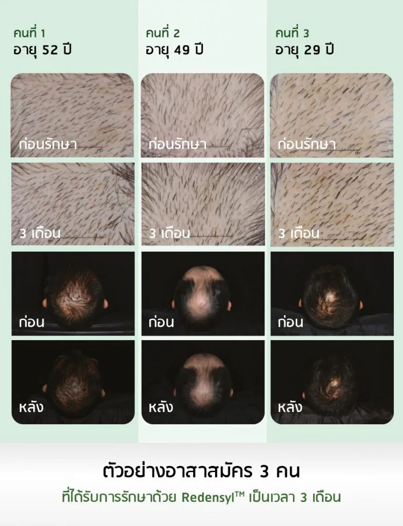 ผลการทดสอบทางคลินิกของ Redensyl™ กระตุ้นผมงอกใหม่กว่า 10,200 เส้น