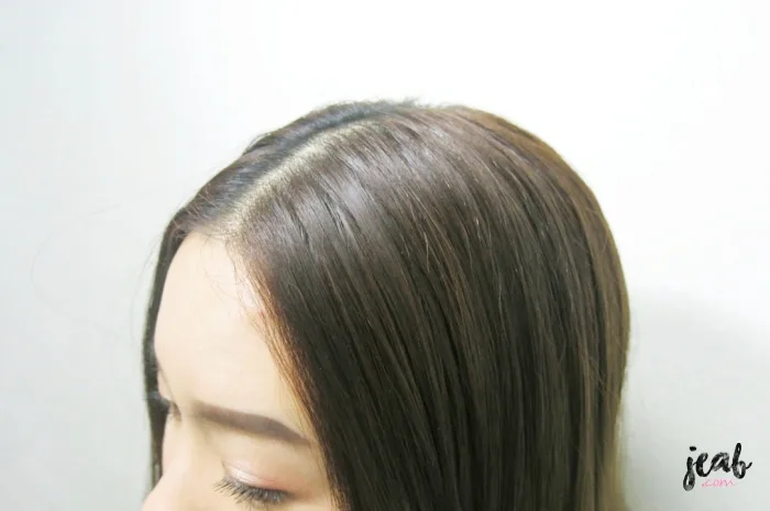 สภาพหนังศีรษะมันคันที่ต้องการการดูแล