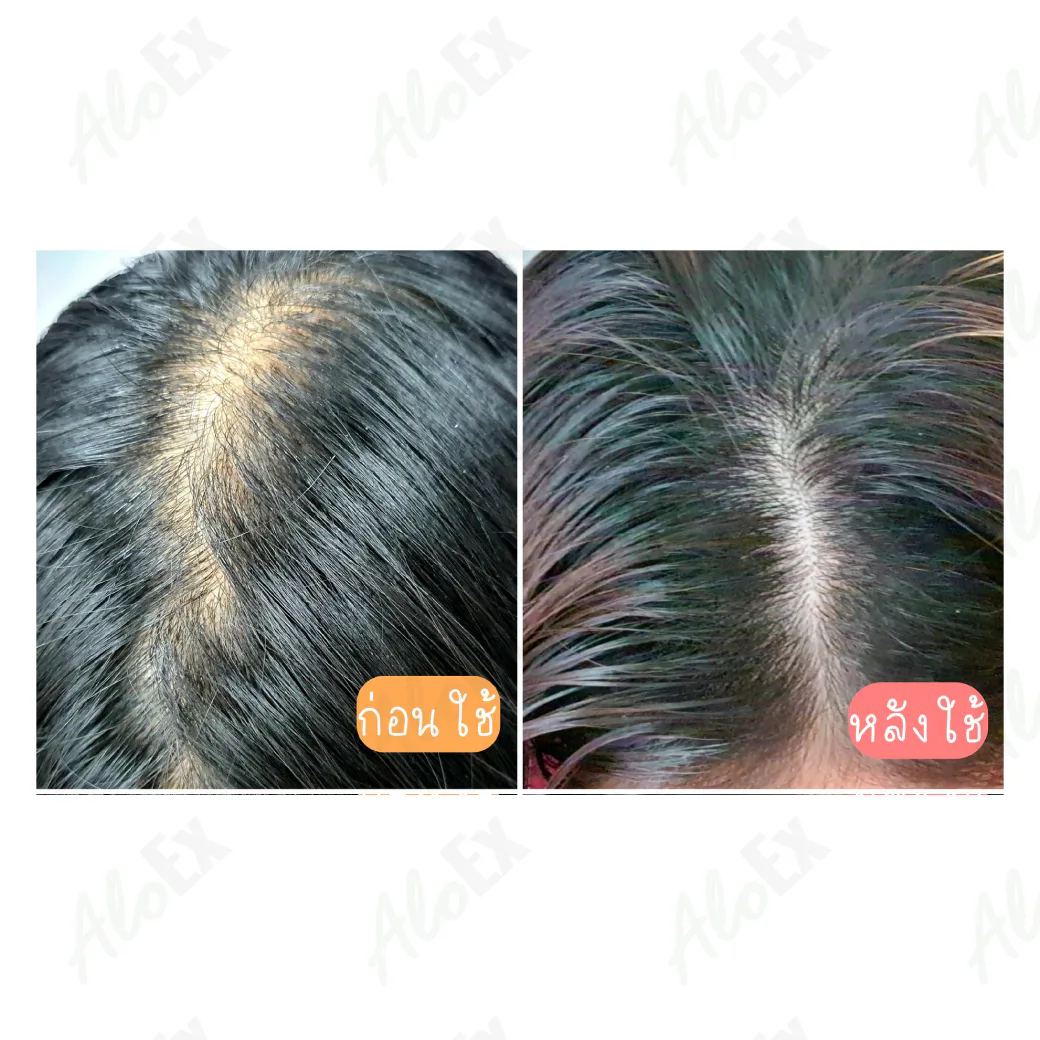 ก่อนใช้-หลังใช้ ผลิตภัณฑ์ AloEx