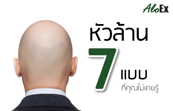 หัวล้าน 7แบบที่คุณไม่เคยรู้
